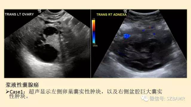 【PPT】卵巢常见囊性病变影像诊断