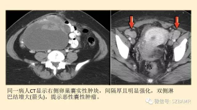 【PPT】卵巢常见囊性病变影像诊断