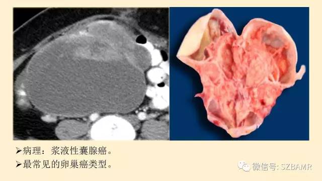 【PPT】卵巢常见囊性病变影像诊断