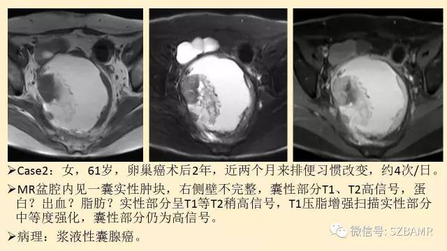 【PPT】卵巢常见囊性病变影像诊断