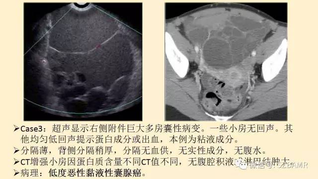 【PPT】卵巢常见囊性病变影像诊断