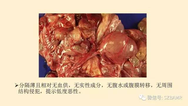 【PPT】卵巢常见囊性病变影像诊断
