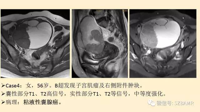 【PPT】卵巢常见囊性病变影像诊断