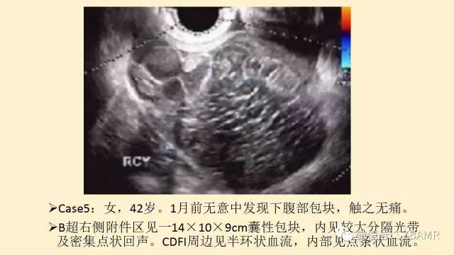 【PPT】卵巢常见囊性病变影像诊断