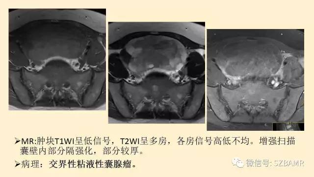【PPT】卵巢常见囊性病变影像诊断