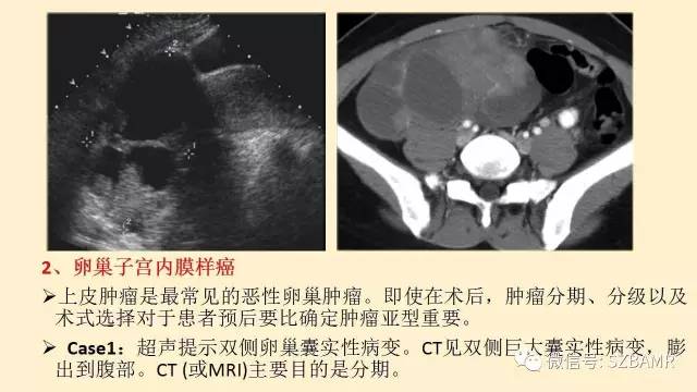 【PPT】卵巢常见囊性病变影像诊断
