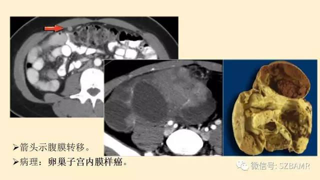 【PPT】卵巢常见囊性病变影像诊断