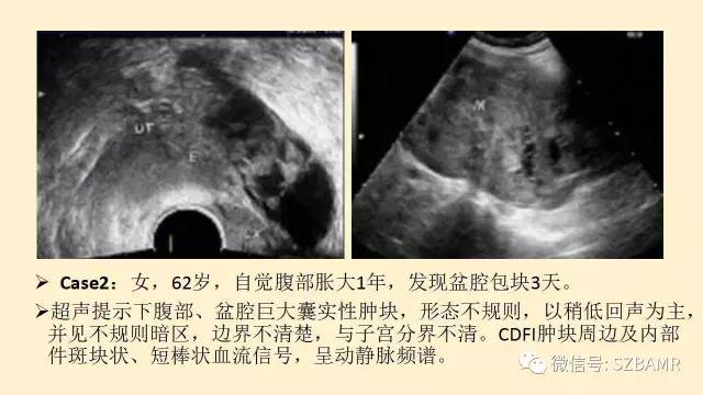 【PPT】卵巢常见囊性病变影像诊断