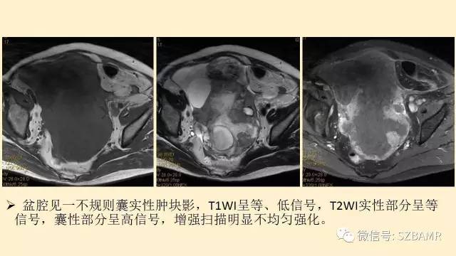 【PPT】卵巢常见囊性病变影像诊断