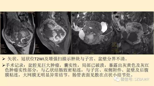 【PPT】卵巢常见囊性病变影像诊断