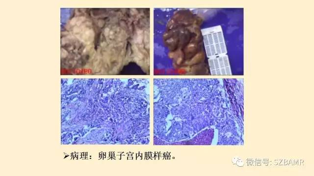 【PPT】卵巢常见囊性病变影像诊断