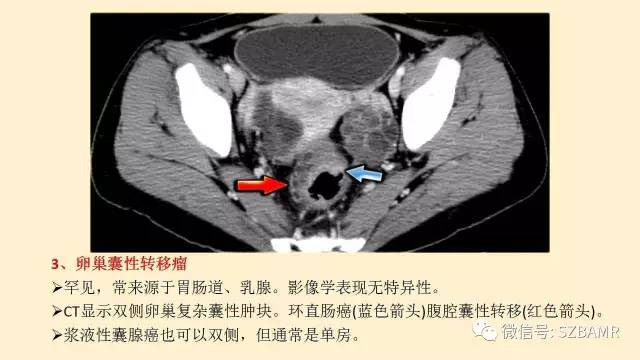 【PPT】卵巢常见囊性病变影像诊断