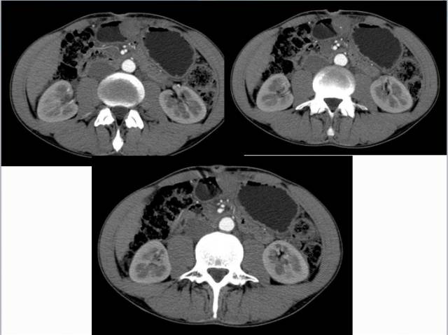 【病例】胃炎性肌纤维母细胞瘤1例CT 【病例】胃炎性肌纤维母细胞瘤1例CT