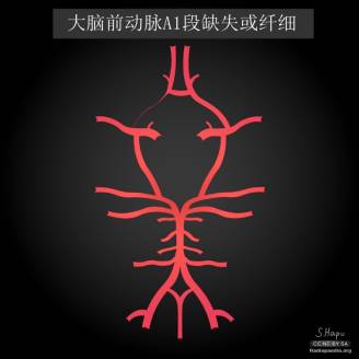 大脑Willis环的解剖及变异 大脑Willis环的解剖及变异