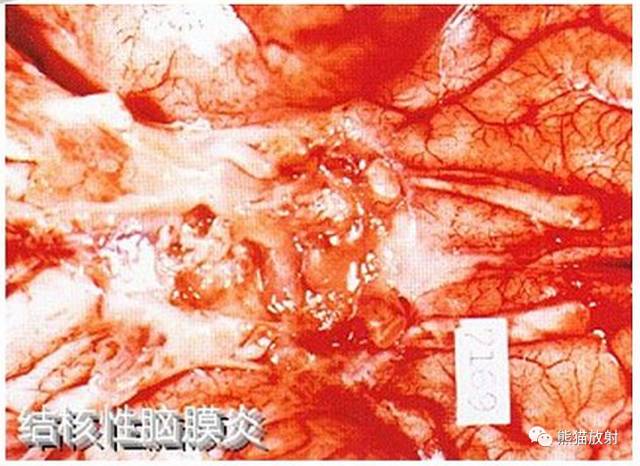 颅内感染性疾病——结核性脑膜炎、结核瘤影像病理 颅内感染性疾病——结核性脑膜炎、结核瘤影像病理