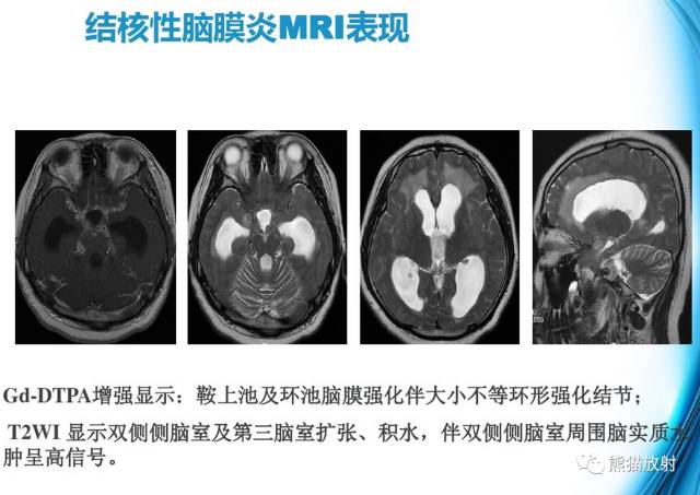 颅内感染性疾病——结核性脑膜炎、结核瘤影像病理 颅内感染性疾病——结核性脑膜炎、结核瘤影像病理