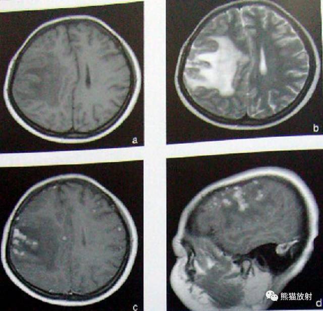 颅内感染性疾病——结核性脑膜炎、结核瘤影像病理 颅内感染性疾病——结核性脑膜炎、结核瘤影像病理