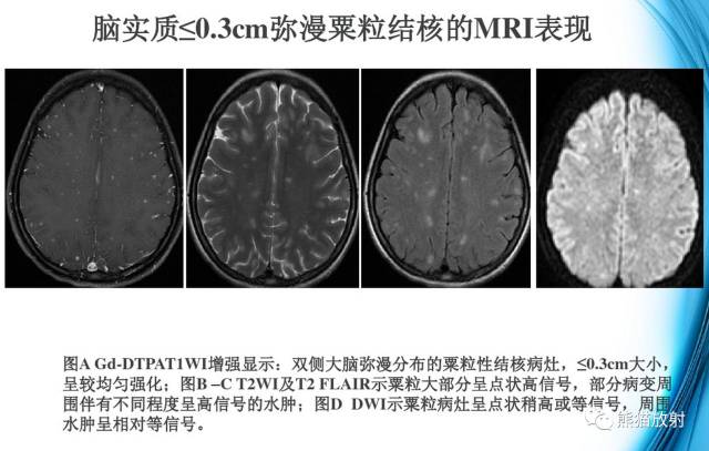 颅内感染性疾病——结核性脑膜炎、结核瘤影像病理 颅内感染性疾病——结核性脑膜炎、结核瘤影像病理