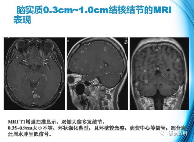 颅内感染性疾病——结核性脑膜炎、结核瘤影像病理 颅内感染性疾病——结核性脑膜炎、结核瘤影像病理