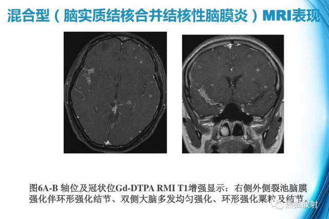 颅内感染性疾病——结核性脑膜炎、结核瘤影像病理 颅内感染性疾病——结核性脑膜炎、结核瘤影像病理