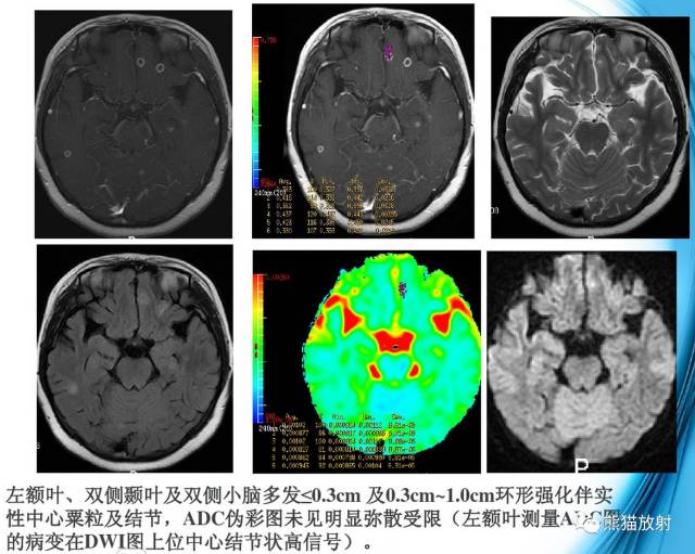 颅内感染性疾病——结核性脑膜炎、结核瘤影像病理 颅内感染性疾病——结核性脑膜炎、结核瘤影像病理
