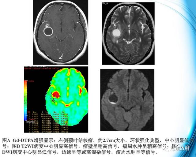 颅内感染性疾病——结核性脑膜炎、结核瘤影像病理 颅内感染性疾病——结核性脑膜炎、结核瘤影像病理