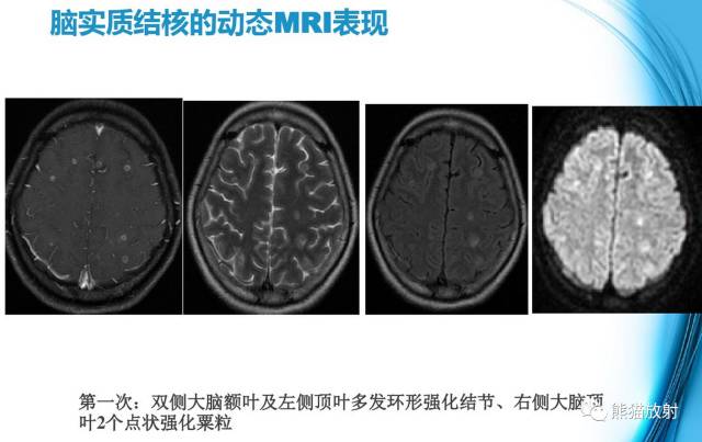颅内感染性疾病——结核性脑膜炎、结核瘤影像病理 颅内感染性疾病——结核性脑膜炎、结核瘤影像病理