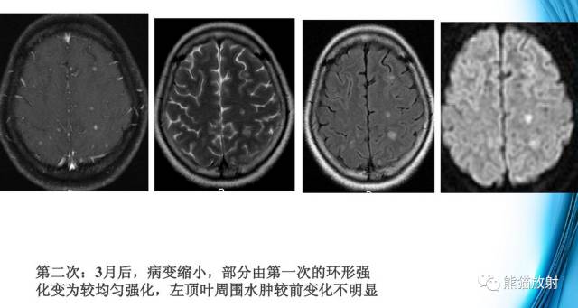 颅内感染性疾病——结核性脑膜炎、结核瘤影像病理 颅内感染性疾病——结核性脑膜炎、结核瘤影像病理