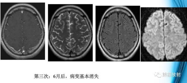 颅内感染性疾病——结核性脑膜炎、结核瘤影像病理 颅内感染性疾病——结核性脑膜炎、结核瘤影像病理