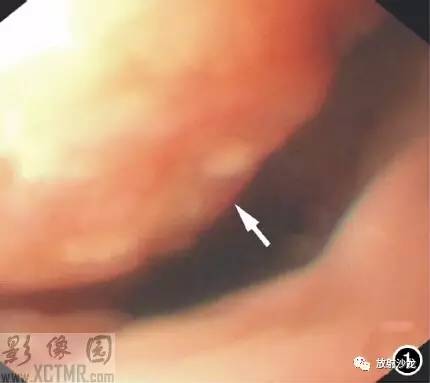【病例】食管淋巴瘤1例X线CT影像表现