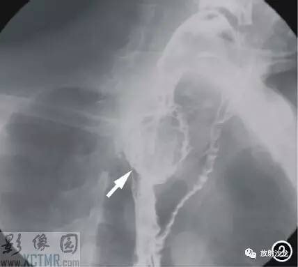 【病例】食管淋巴瘤1例X线CT影像表现 【病例】食管淋巴瘤1例X线CT影像表现
