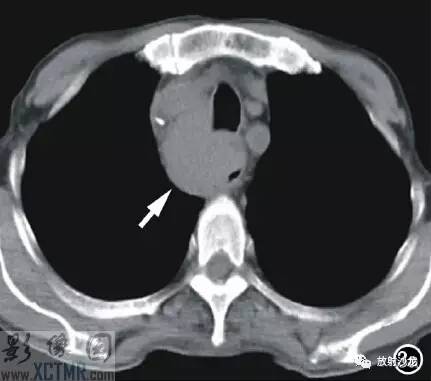 【病例】食管淋巴瘤1例X线CT影像表现