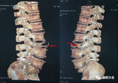 【病例】孤立性浆细胞骨髓瘤2例X线CT及MR影像表现