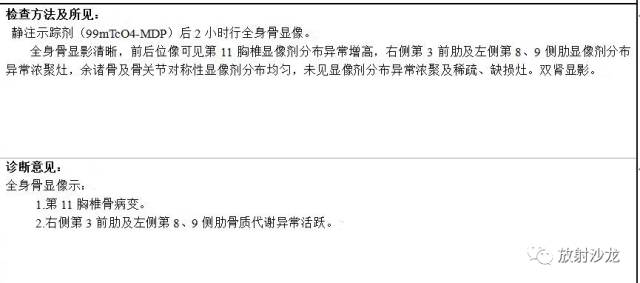 【病例】孤立性浆细胞骨髓瘤2例X线CT及MR影像表现