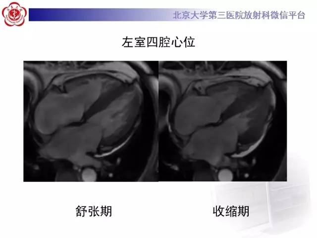 【病例】心肌淀粉样变性1例MR影像诊断