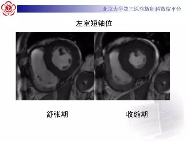 【病例】心肌淀粉样变性1例MR影像诊断