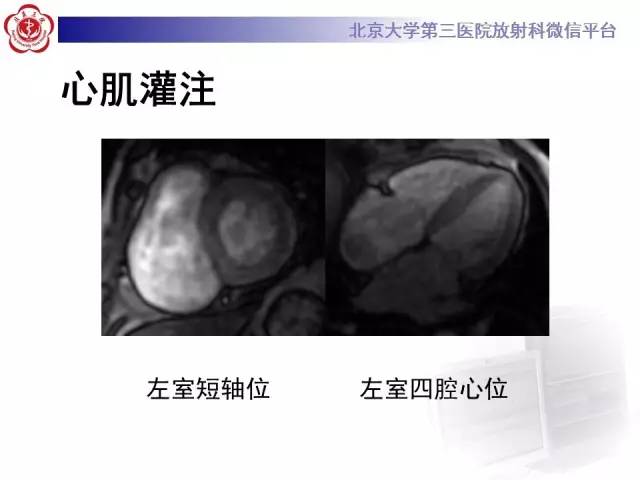 【病例】心肌淀粉样变性1例MR影像诊断