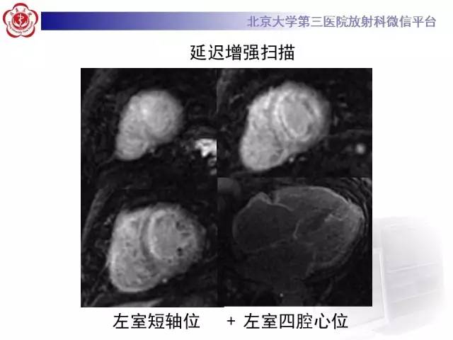【病例】心肌淀粉样变性1例MR影像诊断