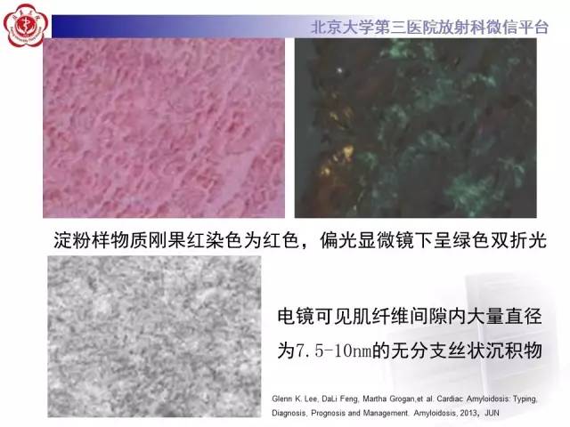 【病例】心肌淀粉样变性1例MR影像诊断