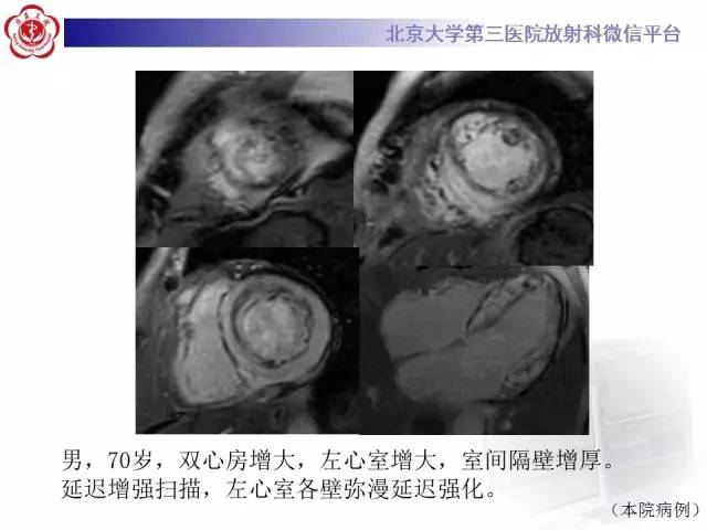 【病例】心肌淀粉样变性1例MR影像诊断