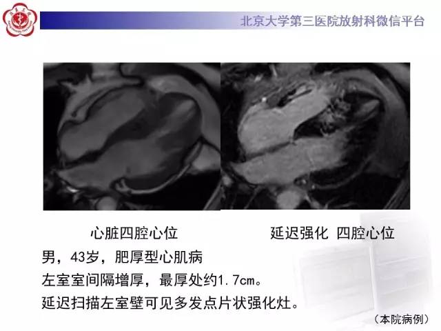【病例】心肌淀粉样变性1例MR影像诊断