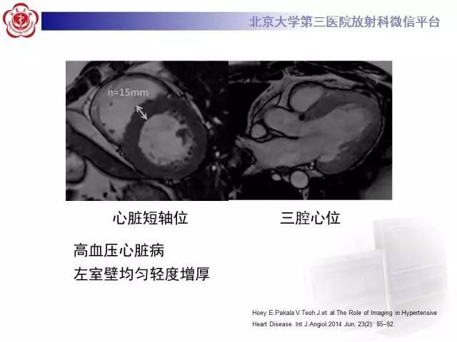 【病例】心肌淀粉样变性1例MR影像诊断