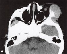 【病例】眼眶血外渗性骨囊肿1例CT 【病例】眼眶血外渗性骨囊肿1例CT
