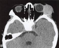 【病例】眼眶血外渗性骨囊肿1例CT 【病例】眼眶血外渗性骨囊肿1例CT