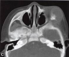 【病例】眼眶血外渗性骨囊肿1例CT 【病例】眼眶血外渗性骨囊肿1例CT