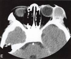 【病例】眼眶血外渗性骨囊肿1例CT 【病例】眼眶血外渗性骨囊肿1例CT
