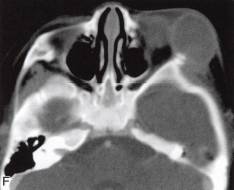 【病例】眼眶血外渗性骨囊肿1例CT 【病例】眼眶血外渗性骨囊肿1例CT