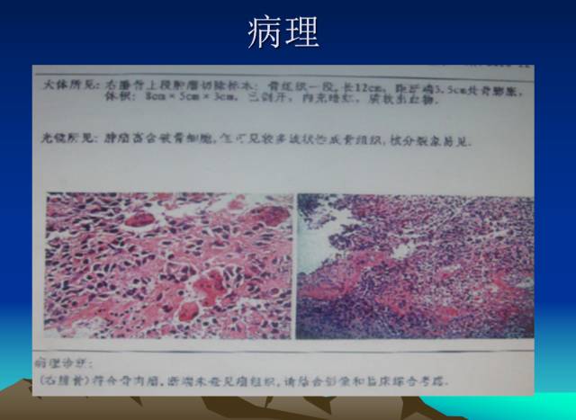 【PPT】恶性骨肿瘤的影像学诊断