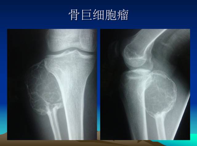 【PPT】恶性骨肿瘤的影像学诊断