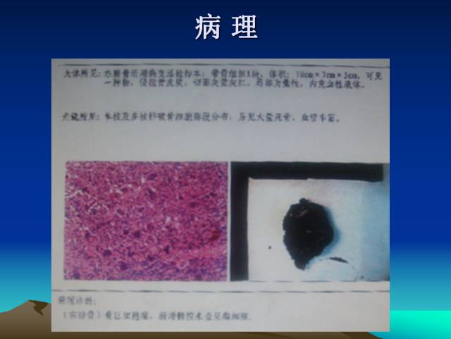【PPT】恶性骨肿瘤的影像学诊断